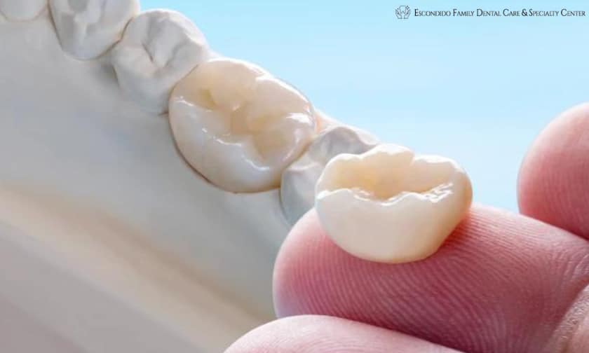 Dental Crowns in Escondido