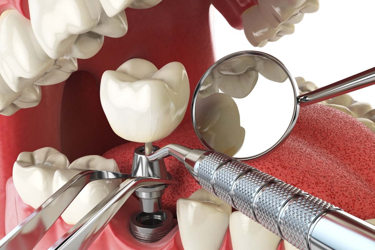 Dental Implants in Escondido