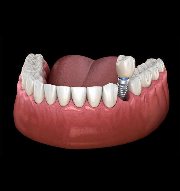 Dental implant model showing prosthetic tooth placement in human jawbone against black background.