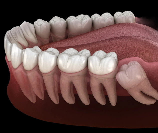 3D dental illustration showing upper and lower teeth with gum tissue and jaw structure.