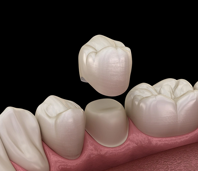 Dental crown placement illustration showing tooth restoration on gum model for cosmetic dentistry.
