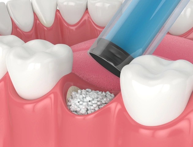 Dental implant placement procedure showing bone graft material being inserted into jawbone between teeth.