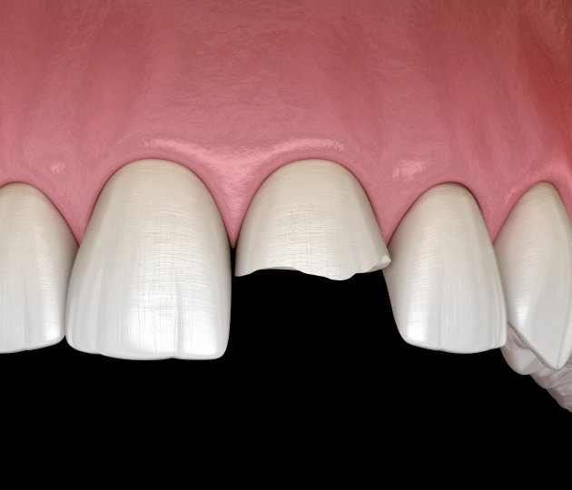 Digital dental model showing missing front tooth gap between white porcelain crowns on pink gum background.