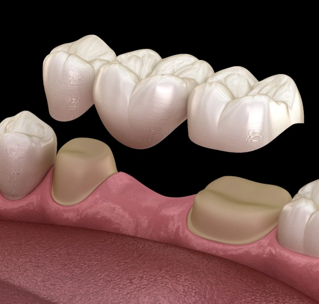 3D dental bridge prosthetic model showing tooth replacement crowns over gum structure
