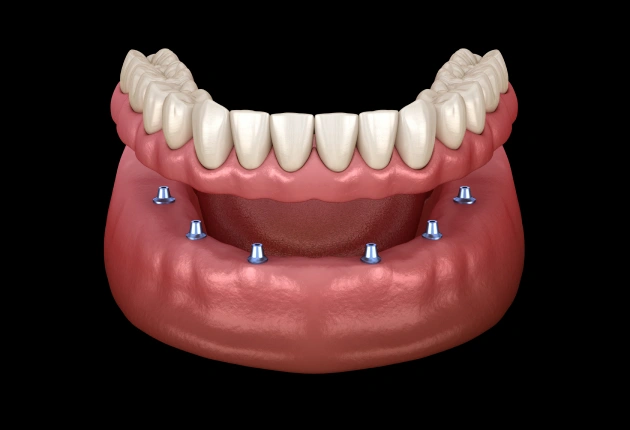 Digital illustration of dental implants in lower jaw with prosthetic teeth restoration.