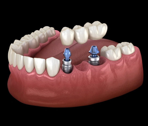 Dental implants model showing titanium posts in jawbone with artificial teeth placement demonstration.