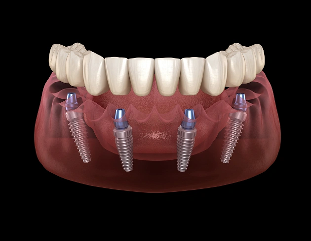 Dental implants with prosthetic teeth on model showing full arch restoration procedure.