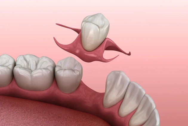 Dental implant placement illustration showing tooth restoration procedure on pink background