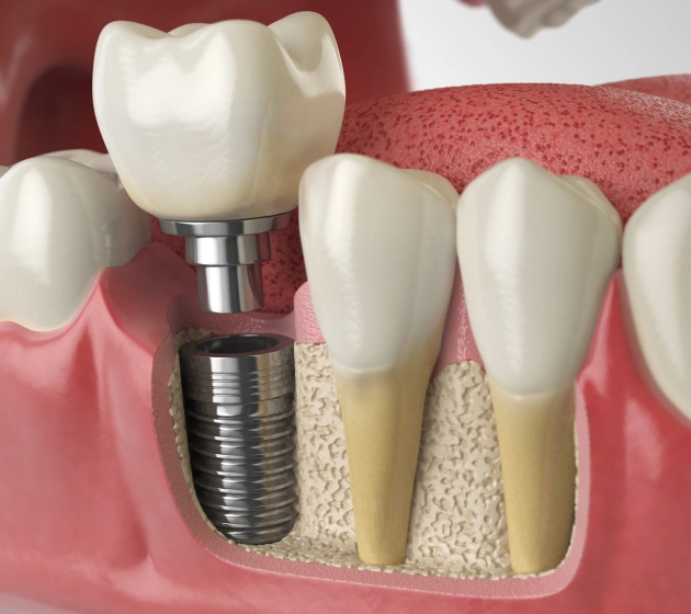 Dental implant model showing titanium screw, abutment, and crown compared to natural teeth.