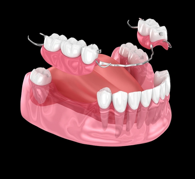 3D dental model showing implant placement and prosthetic teeth on pink jawbone structure against black background.