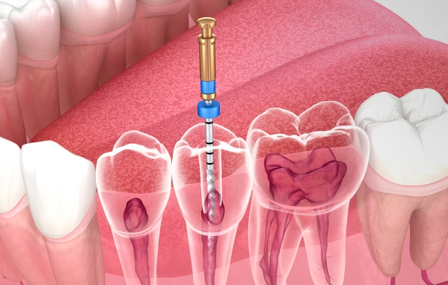 Dental root canal procedure illustration showing tooth cross-section with endodontic treatment components and instruments.