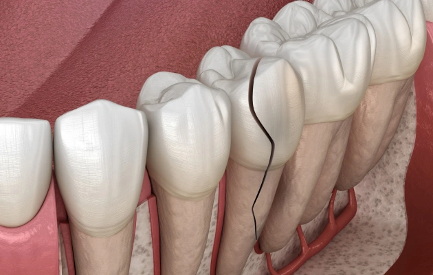 Dental shade guide showing tooth color progression from white to darker shades for cosmetic dentistry matching.