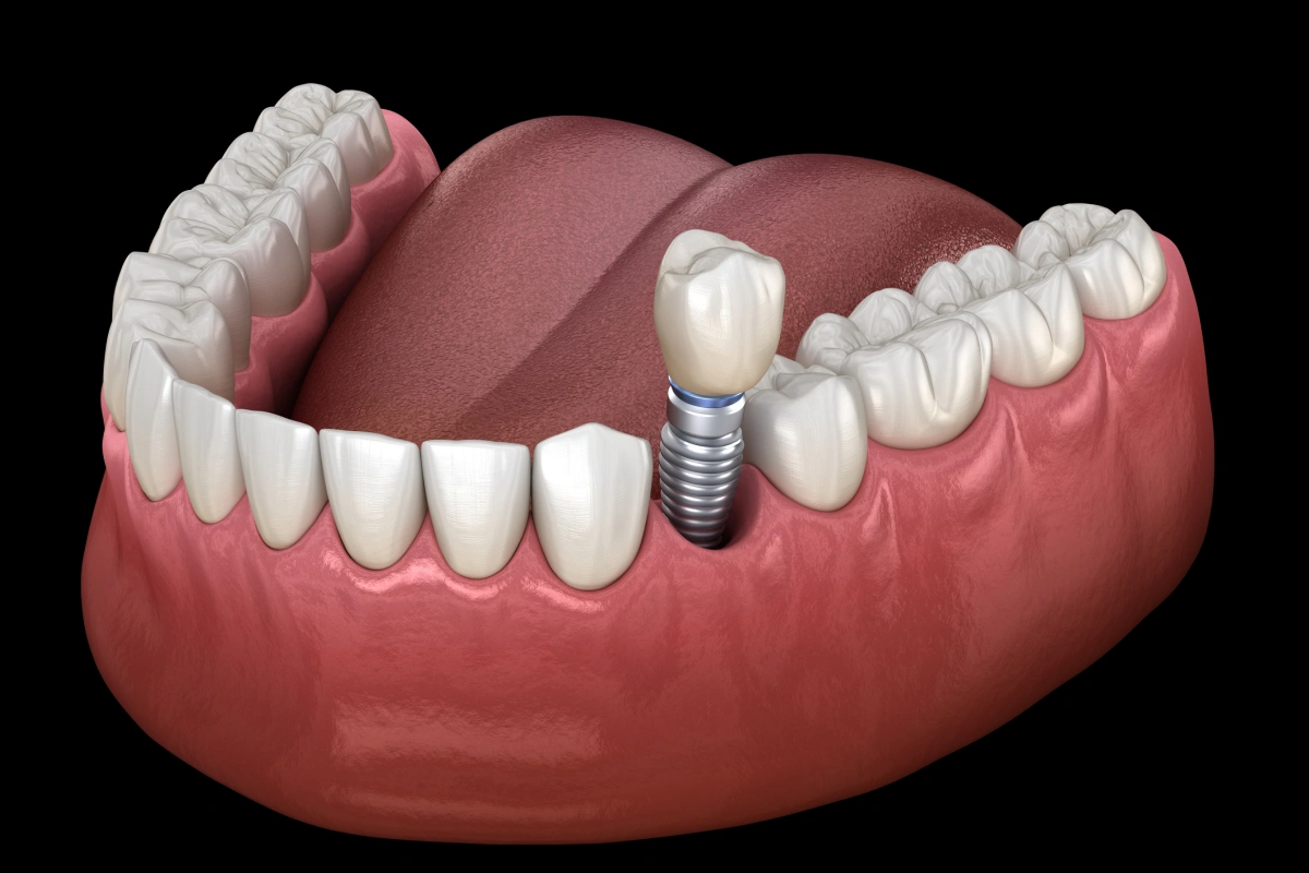 Dental implant model showing titanium post and artificial tooth crown on gum replica.