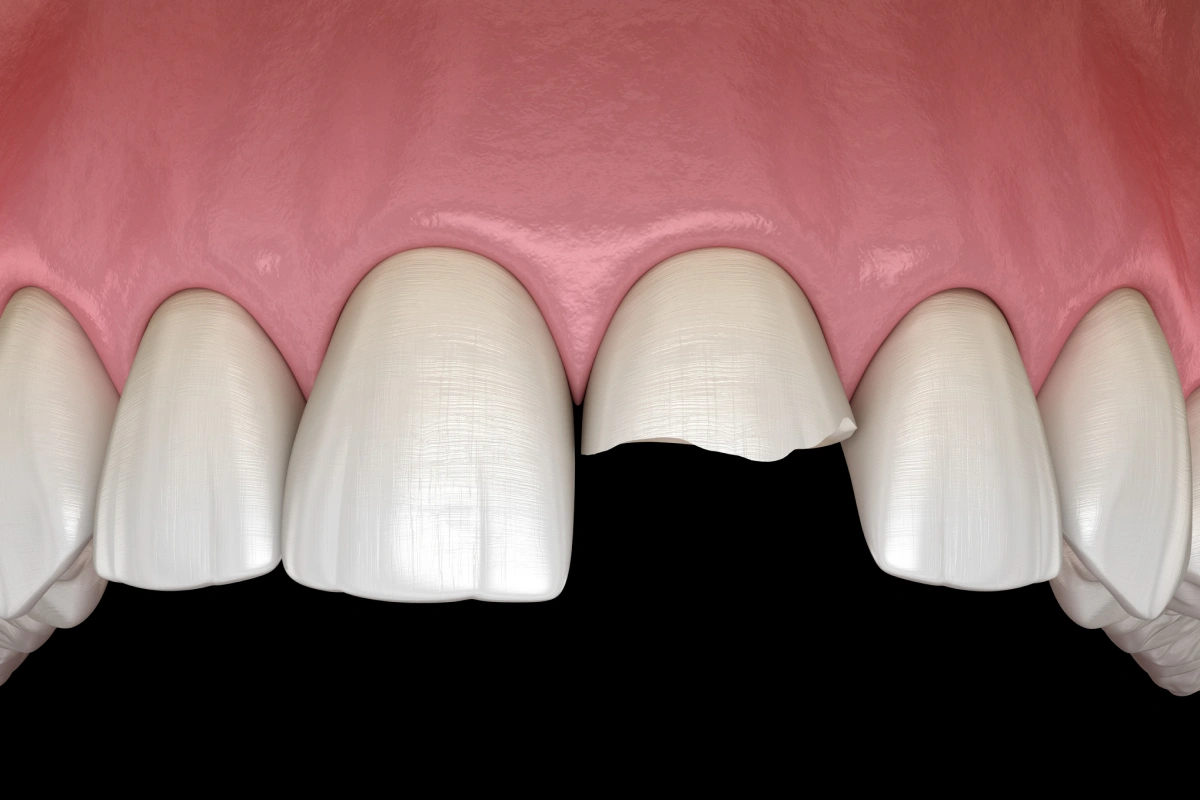 Six dental crowns displayed showing tooth restoration treatment with black background