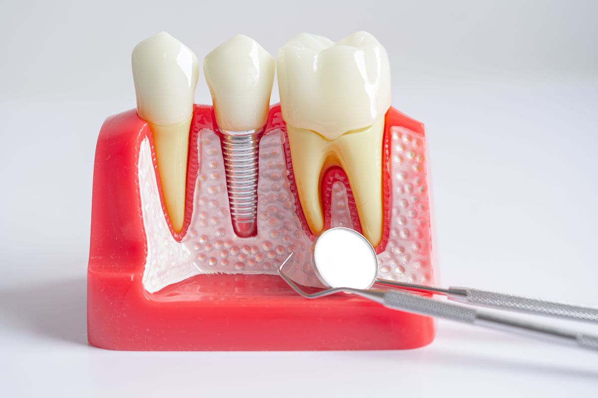 Tooth restoration model highlighting dental implant benefits