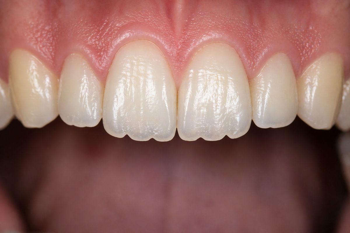 adult teeth with mamelons close-up