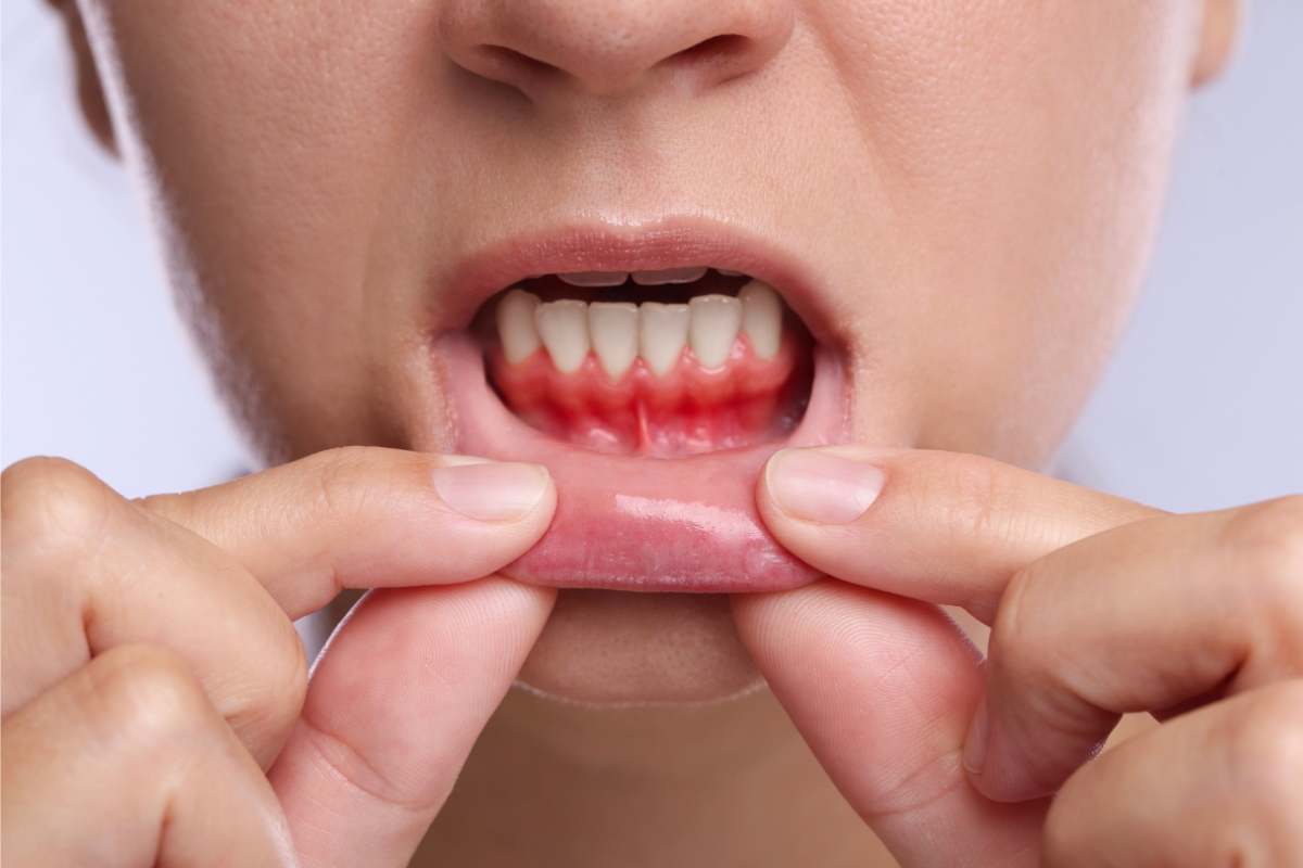 What Is the Best Antibiotic for a Gum Infection