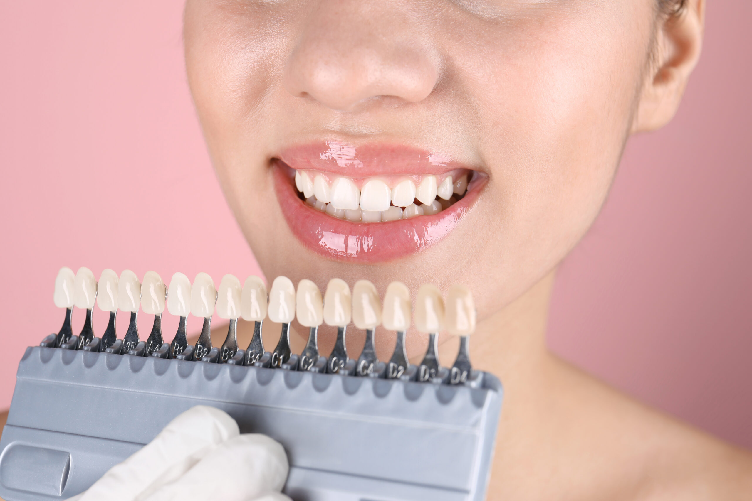 Veneers in Escondido