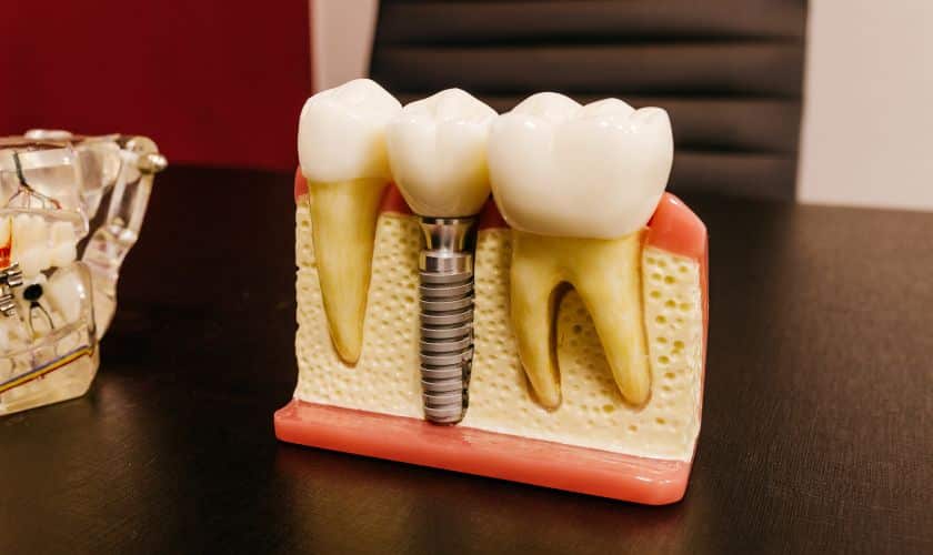 Dental Implants Escondido - Escondido Family Dental Care