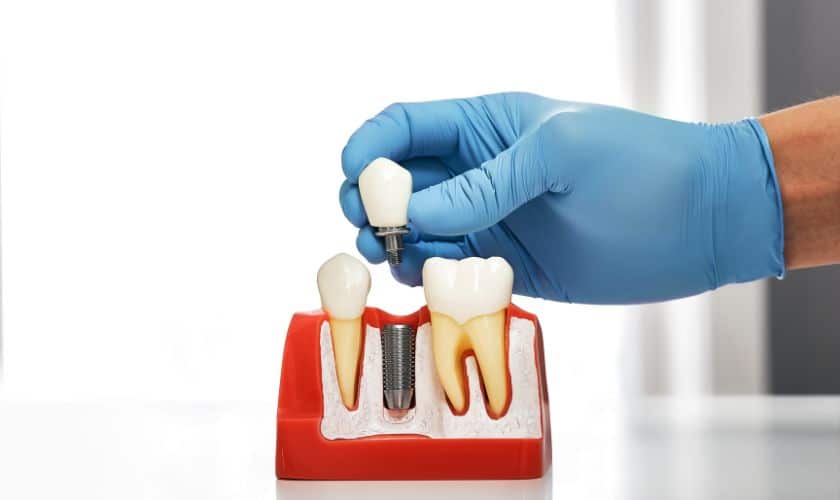Why Dental Implants Are The Best Solution For Missing Teeth In Escondido