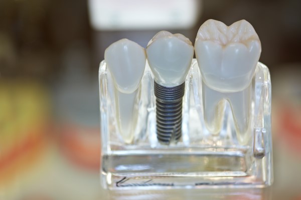 Can You Get Dental Implants In One Day?