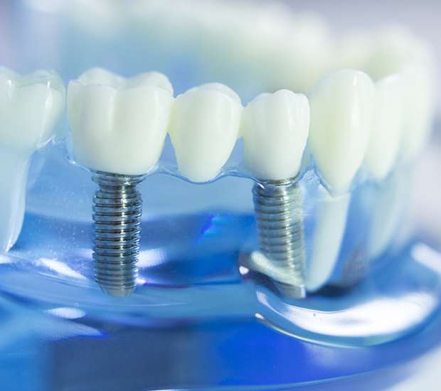 Escondido Dental Implants