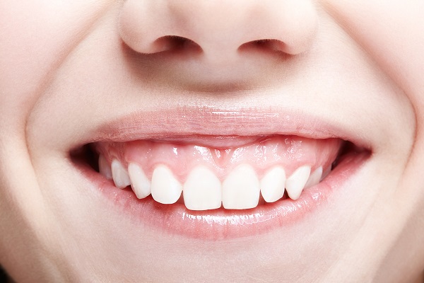 Do Small Teeth Cause A Gummy Smile?
