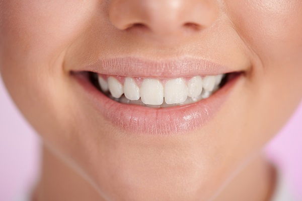What Is Laser Teeth Whitening